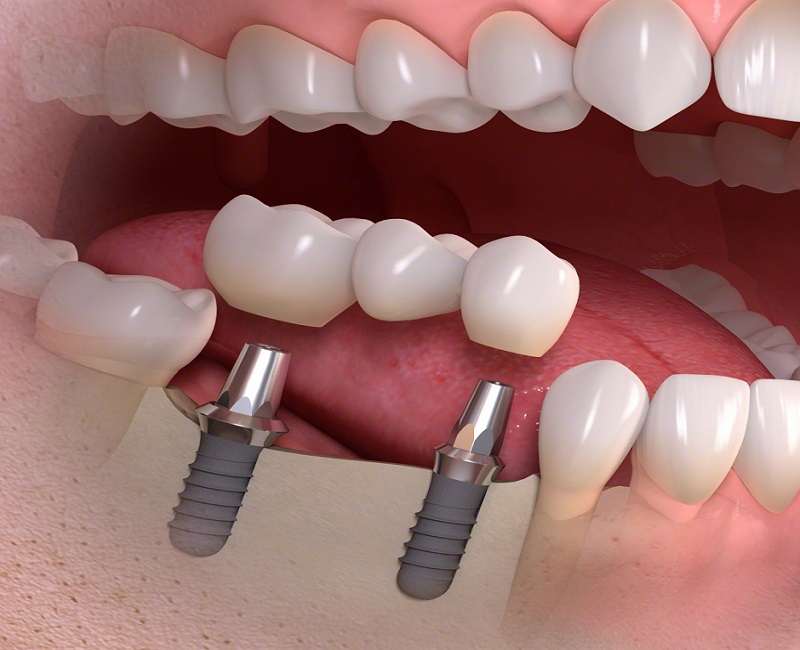Why Dental Implants Are A Popular Treatment For Missing Natural Tooth?